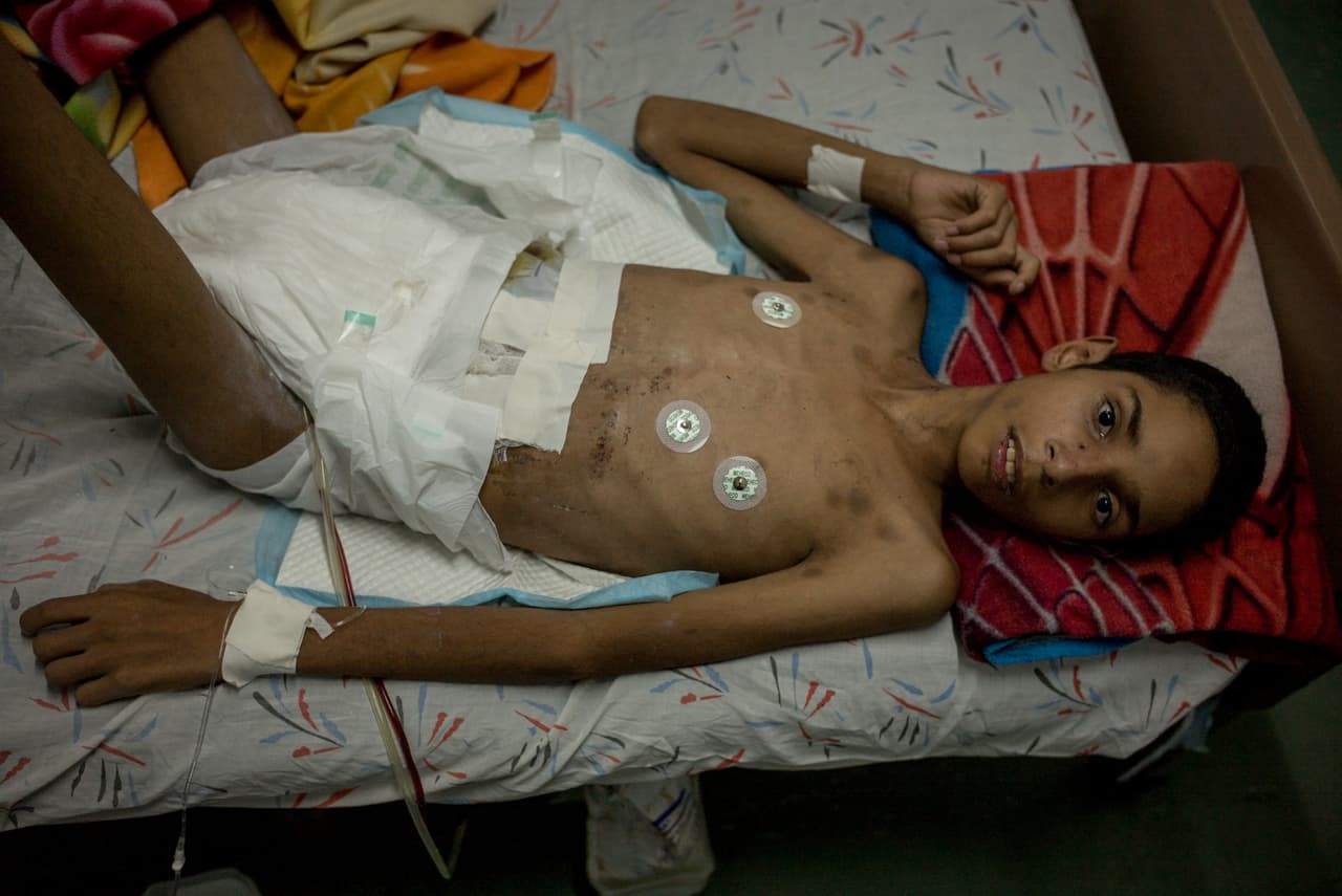 <b>Colapso del sistema de salud. </b> La tasa de mortalidad infantil se ubicó en 18.61 por cada mil nacidos vivos, índice similar al que registró el país a mediados del siglo pasado. 
<b><a href="http://www.univision.com/noticias/america-latina/aqui-no-hay-ni-para-hacer-una-sutura-imagenes-de-un-hospital-venezolano-en-decadencia">La Federación Médica Venezolana informó que 95% de los hospitales enfrenta fallas graves de insumos y medicamentos</a></b>
<a href="http://www.univision.com/noticias/america-latina/aqui-no-hay-ni-para-hacer-una-sutura-imagenes-de-un-hospital-venezolano-en-decadencia">.</a> Un informe que presentó la ONG Transparencia Venezuela ante la ONU señala que 60% de los equipos utilizados para diagnóstico y tratamiento en el sector público está “paralizado”. El 24 de marzo de 2017, el 
<b><a href="http://www.univision.com/temas/nicolas-maduro">presidente de Venezuela </a></b>pidió ayuda a la ONU para regularizar el suministro de medicinas ante 
<b><a href="http://www.univision.com/noticias/medicina-y-farmacia/asi-se-vive-la-escasez-dentro-de-una-farmacia-en-venezuela">escasez que enfrenta en Venezuela</a></b>. "
<b><a href="http://www.univision.com/noticias/america-latina/maduro-le-pide-ayuda-a-la-onu-para-combatir-la-escasez-de-medicamentos-en-venezuela">Le he pedido apoyo a Naciones Unidas para atender heridas económicas y sociales que golpean a nuestro pueblo por la guerra económica</a></b> (...)", afirmó el mandatario. En la foto, un paciente que sufre de denutrición en un hospital público venezolano.