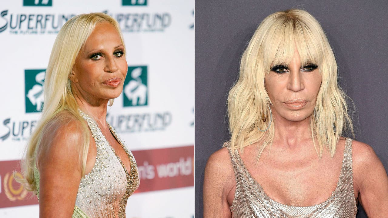 Donatella Versace: la hermana del diseñador de moda Gianni Versace se ha colocado colágeno en los pómulos y relleno en sus labios, que con el pasar de los años se han hecho notar.