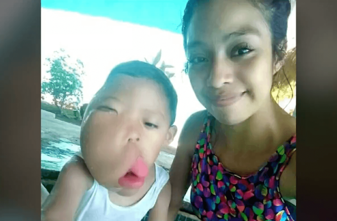 <b>Este niño guatemalteco busca ayuda por una deformación que se agrava con los días</b>
<br>
<br>Moisés Tecun, de 6 años, nació con una deformación en la cara que se ha ido agravando con el tiempo. Su familia no tiene el dinero suficiente en Guatemala para los gastos médicos que requiere un tratamiento y por ello pide ayuda de la comunidad. Él reza todos los días para que se le cumpla su más anhelado sueño: tener un rostro como los demás niños.