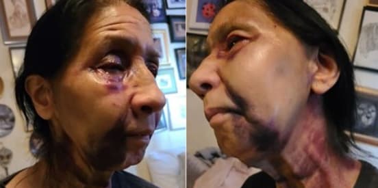 Una hispana de 70 años fue atacada cuando viajaba en el Metro bus hacia un supermercado en la zona de Eagle Rock por una 
<b>pasajera que presuntamente le dirigió comentarios despectivos al confundirla con una persona asiática.</b> Sin embargo, la mujer es mexico-americana y residente de la zona de Highland Park.