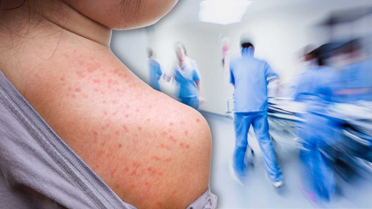 Caso de sarampión en el norte de California expone a cientos de personas a posible contagio