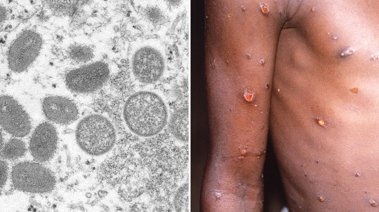 Viruela del mono: reportan posible contagio en residente del condado de Alameda