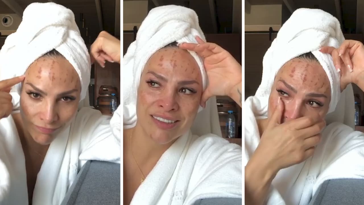 Fabiola Campomanes muestra las heridas que le dejó un tratamiento facial y hace un llamado a no obsesionarse