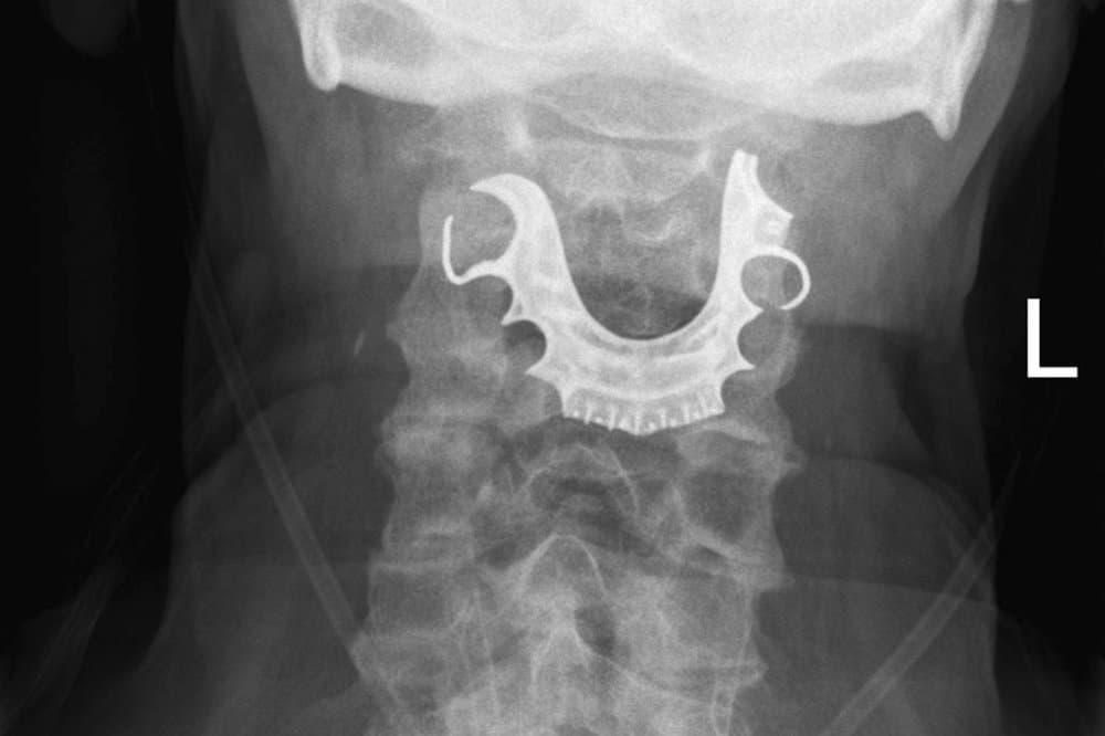 Perdió su dentadura luego de una cirugía y 8 días después la encontraron atascada en su garganta