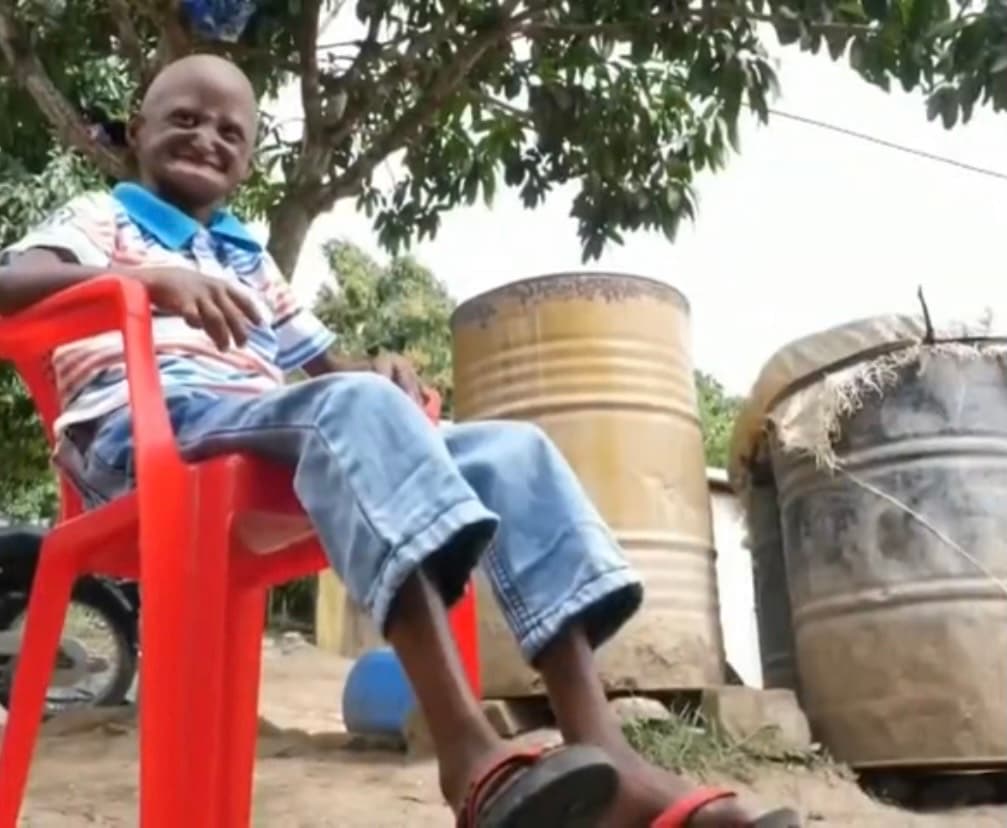 No fue hasta que un grupo de médicos misioneros les ofrecieron ayuda a Walmeli y a fu familia campesiona, habitantes de una apartada comunidad llamada El Seibo. Tras varias evaluaciones y 21 años después de haber nacido, 
<b>el joven fue diagnosticado por primera vez con progeria</b>, una rara enfermedad genética que va afectando principalmente a los tejidos del cuerpo y que se da entre los primeros 2 años de vida. 
<br>
<br>
<br>
<br>