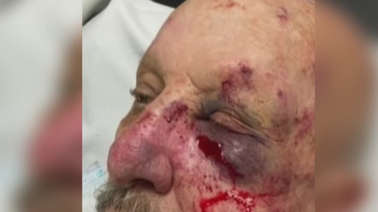 La víctima sufrió varias fracturas y hemorragias, además le hicieron una cirugía para reconstruir parte de su rostro.