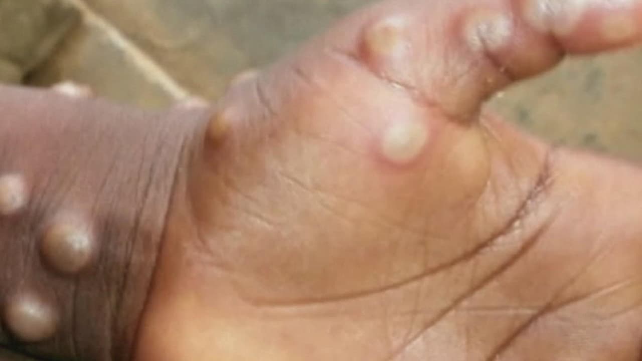 La viruela del mono fue declarada emergencia de salud pública