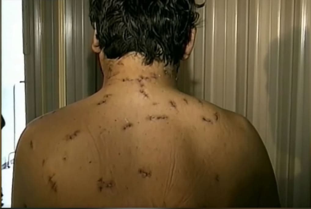 Heridas en la espalda y cuello que mostró Moisés Padilla en febrero de 1998.