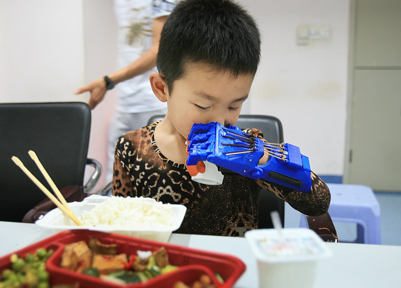 ¡Le dieron una mano artificial!