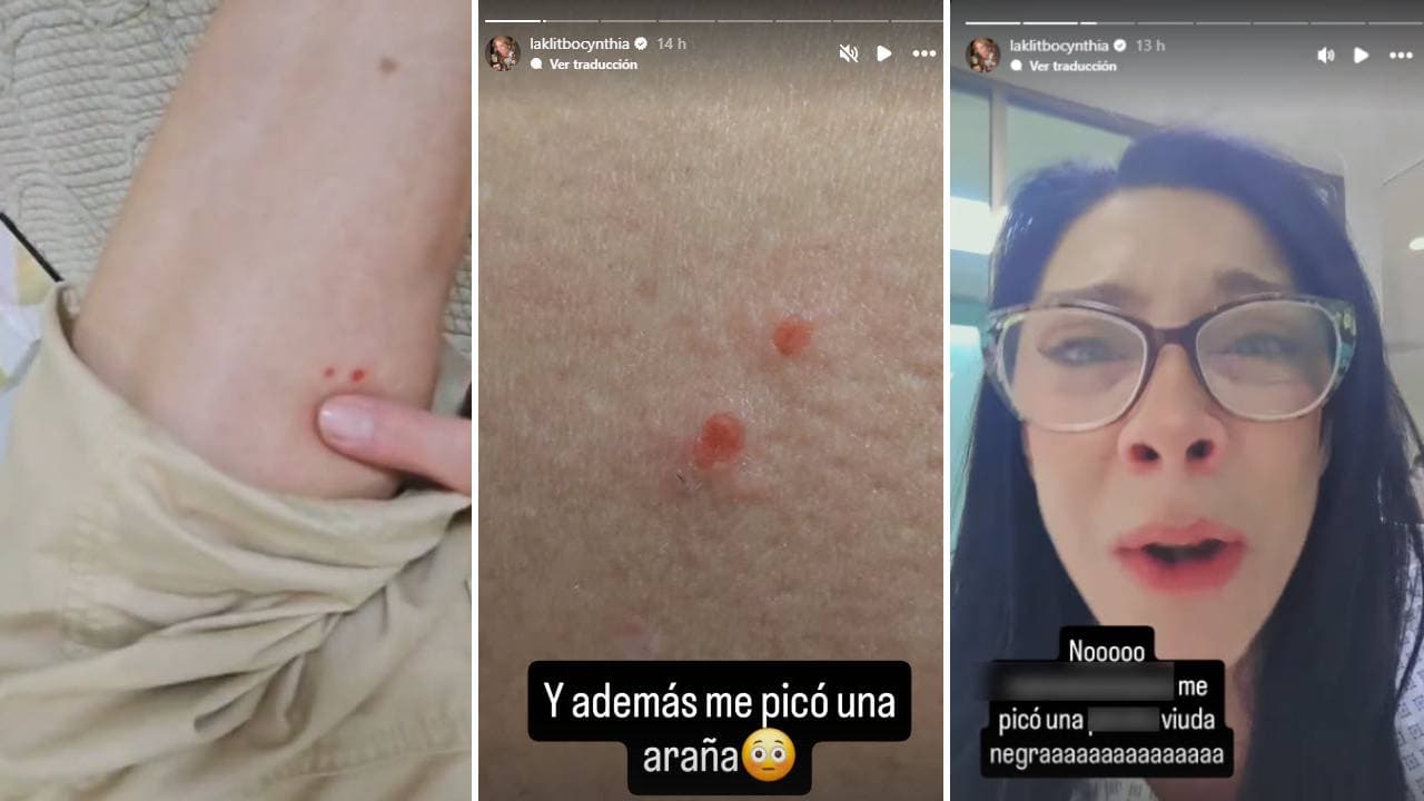 Cynthia Klitbo fue hospitalizada de emergencia por la mordedura de una araña viuda negra.