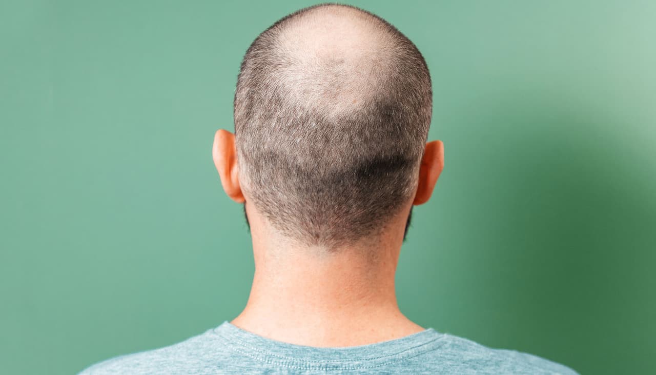 ¿Te estás quedando sin cabello? Este fármaco barato tomado en pastillas podría ser la solución