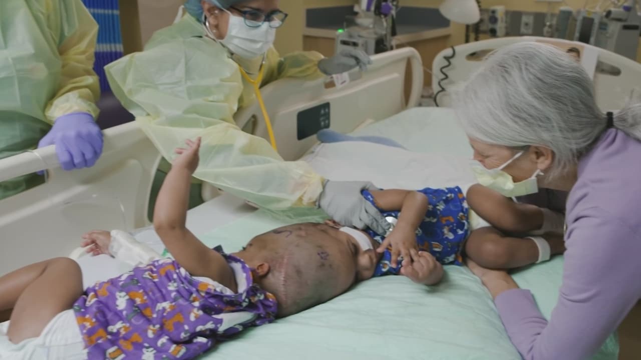 En el Hospital Infantil Cardinal Glennon logran separar con éxito a gemelas unidas por la parte superior de la cabeza