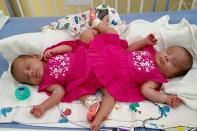 Primer vestido de las siamesas Scarlet y Ximena.