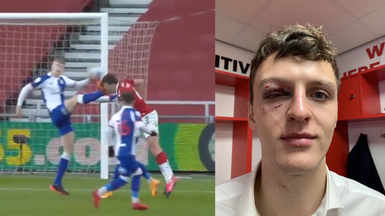 Pasó en Inglaterra: Cerca de perder el ojo y no marcaron penal