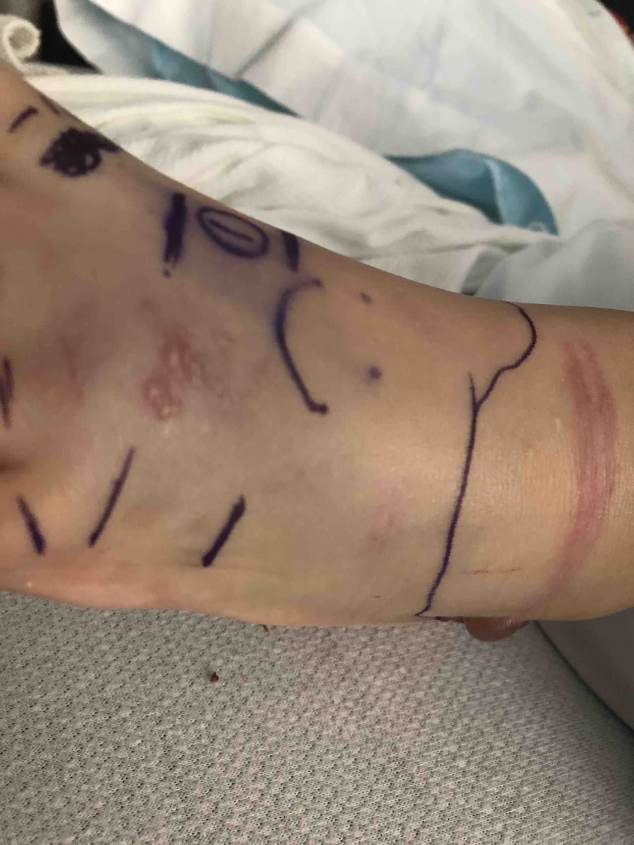 La mordedura ocurrió más arriba del tobillo.