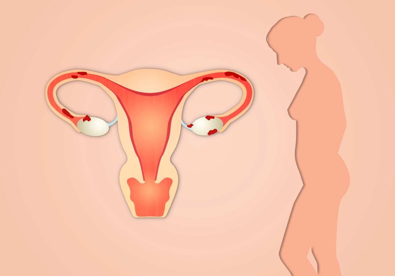 El cáncer de ovarios es una enfermedad que genera más muertes que otros cánceres que atacan el sistema reproductivo femenino.