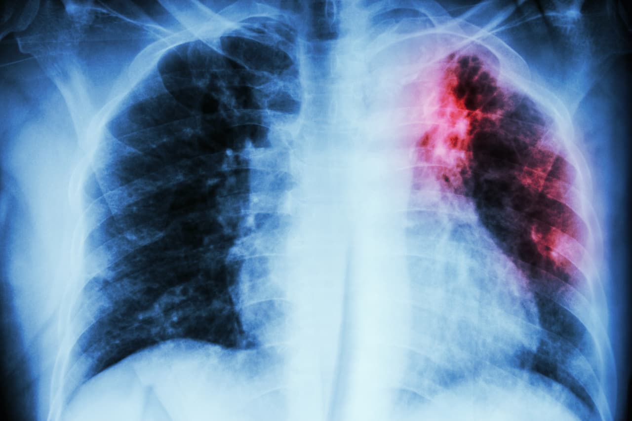 <h3 class="cms-H3-H3">23. Tuberculosis</h3>
<br>
<br>🏥 
<b>Crecimiento en costo por caso de acuerdo con el Índice de Gastos Médicos: </b>3.38
<br>
<br>🏥 
<b>Aumento del gasto en los últimos 10 años registrados: </b>108.9%
<br>