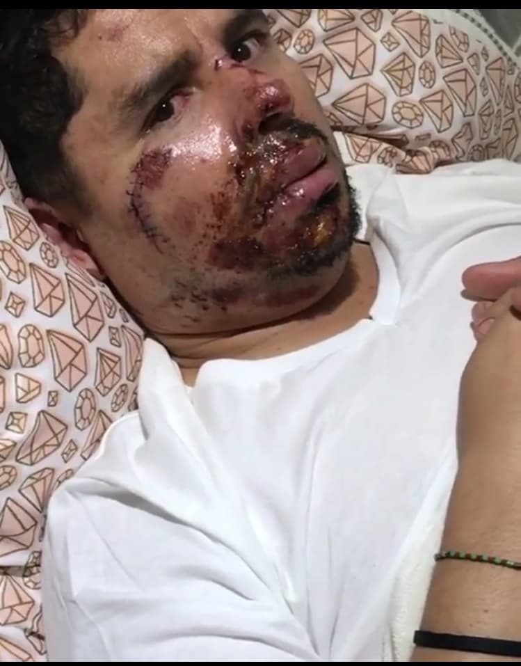 De fondo se escucha la voz de una mujer que está tomando el video, quien relata que el cantante de regional mexicano necesita la ayuda de un cirujano plástico pues las costras y puntadas en su cara le están dejando cicatrices a Larry.