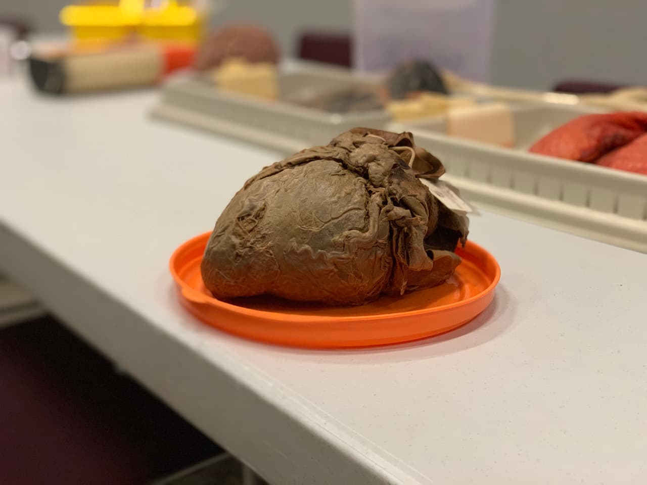 Este corazón pertenecía a un hombre de 34 años quien murió luego de auto recetarse sustancias controladas para incrementar la masa muscular y su corazón creció tanto que le costo la vida.