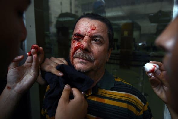 Durante las protestas del 12 de febrero decenas de civiles fueron heridos por disparos de balas de goma y perdigones.