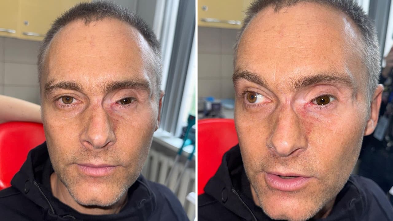 Paciente tras cirugía reconstructiva en Ucrania, luego de una lesión facial causada por la guerra.