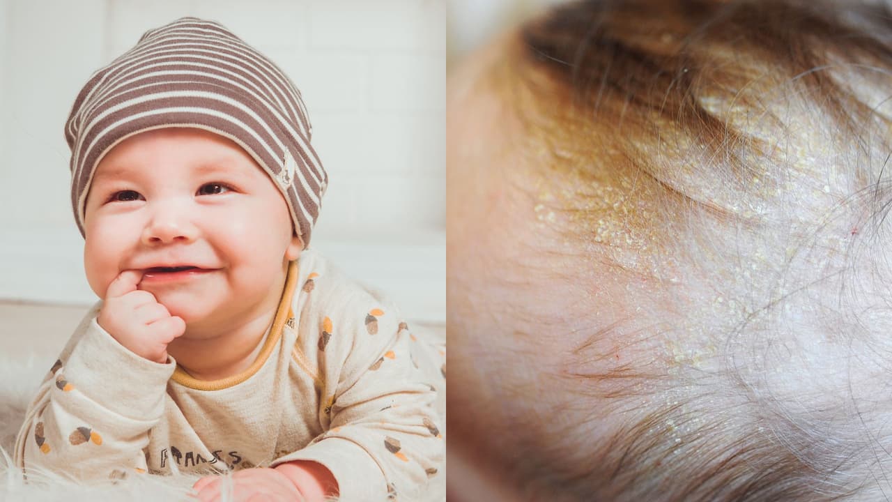 Así puedes eliminar la costra láctea de tu bebé sin lastimar su piel