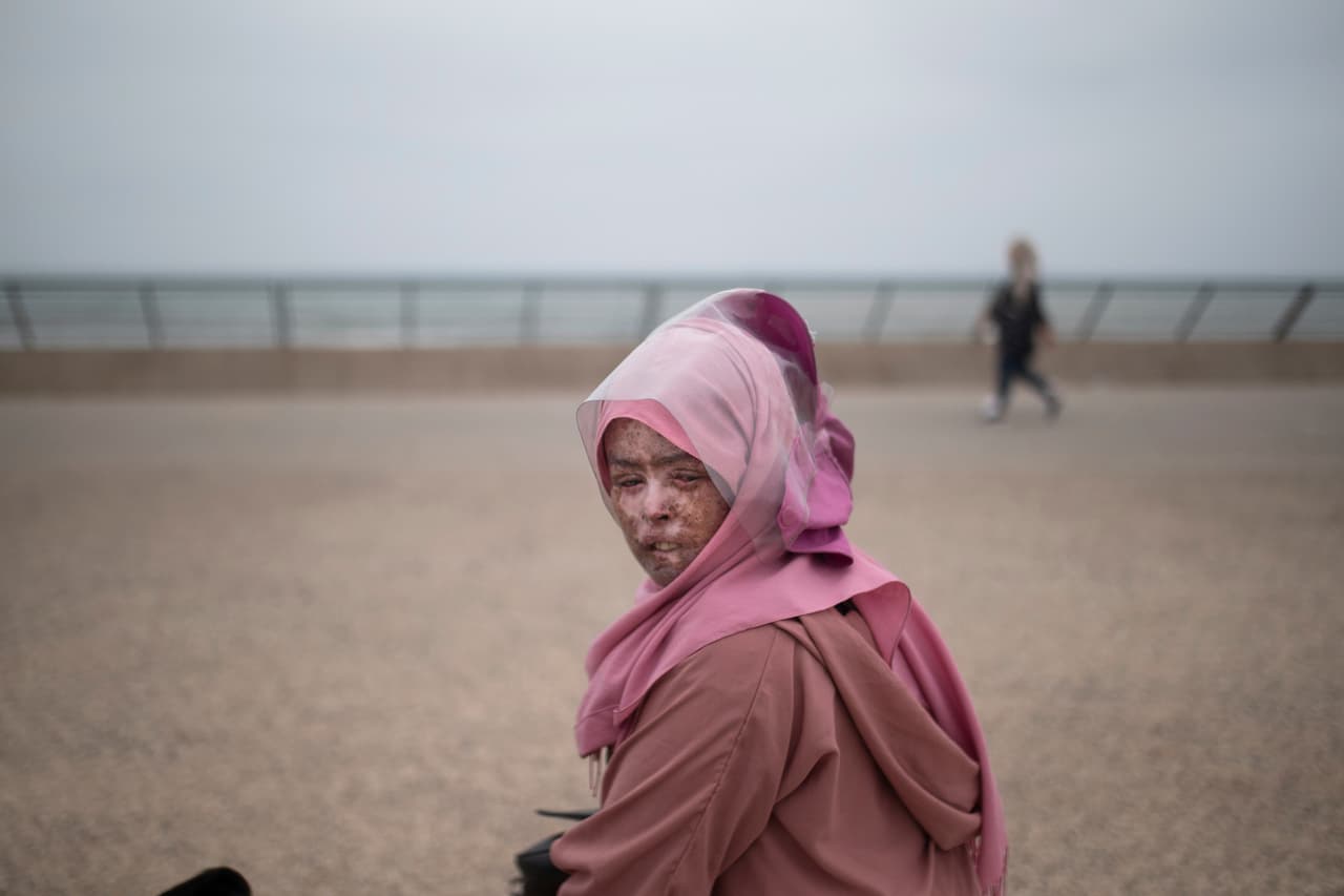 Fatimazehra Belloucy, de 25 años, ha lidiado con cáncer de piel y otros problemas debido a la XP. “Si solo la gente lo hiciera más fácil. Sus palabras duelen. Me siento completamente alienada ”, dijo, describiendo cómo enfrenta miradas asustadas y comentarios de odio cuando pasa. Su familia limita las interacciones con ella, temerosa de que la enfermedad sea contagiosa.