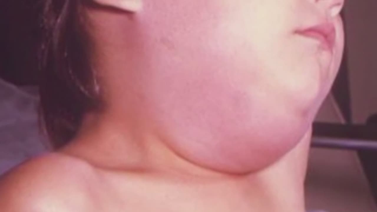 Autoridades de salud reportan más de 40 casos de paperas en el norte de Texas 