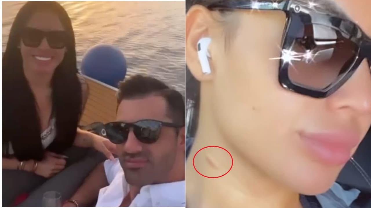 Novia de Toni Costa revela qué son las marcas rojas que aparecen en su cuello (él tiene que ver)
