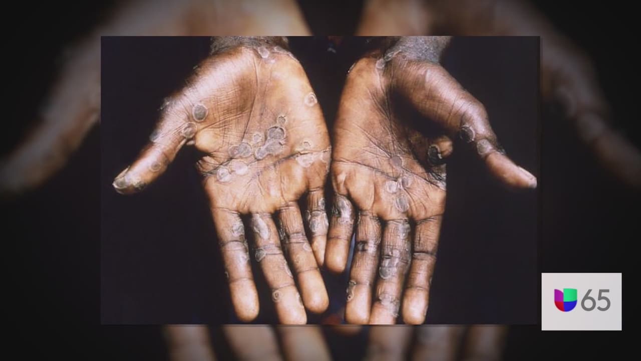 Departamento de Salud Pública de Filadelfia confirma primer caso de viruela del mono en Pensilvania