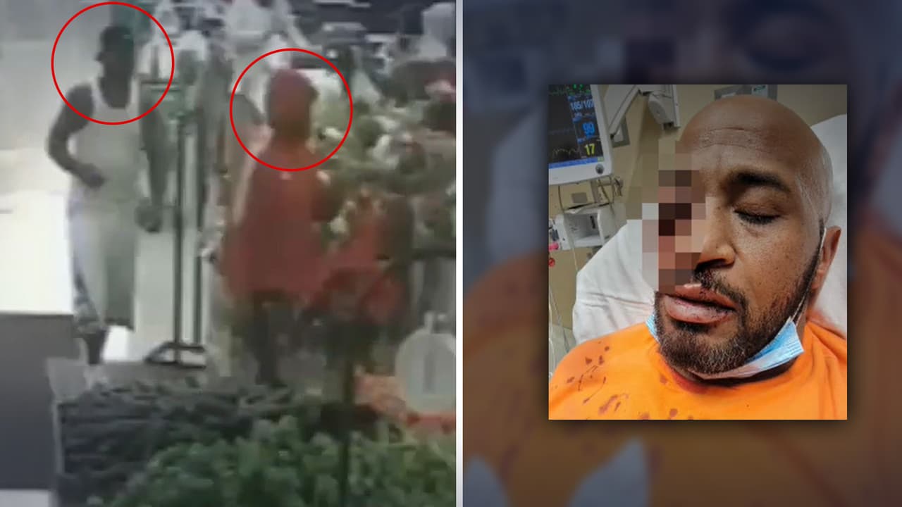 Lo roban en un supermercado y lo golpean tan fuerte que los médicos deben quitarle un ojo