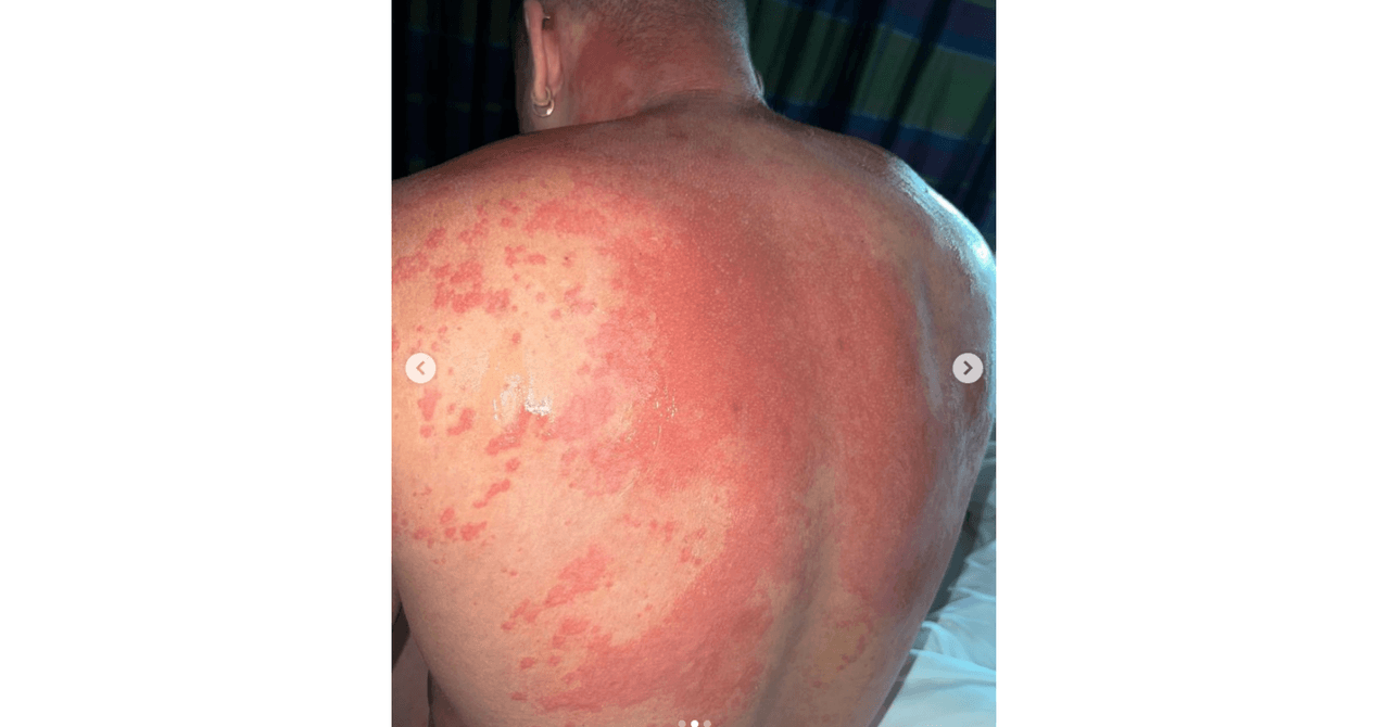 Prince Royce fue hospitalizado por una reacción alérgica