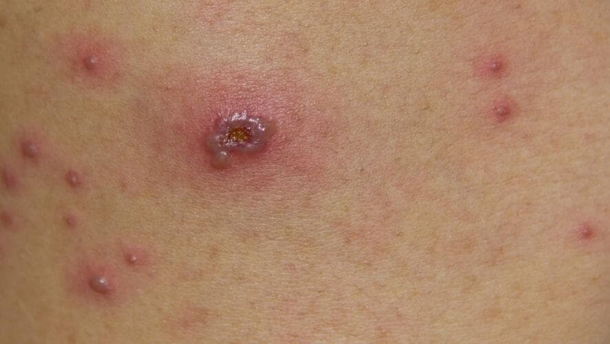 Viruela del mono: detectan primer caso en el condado de Tulare