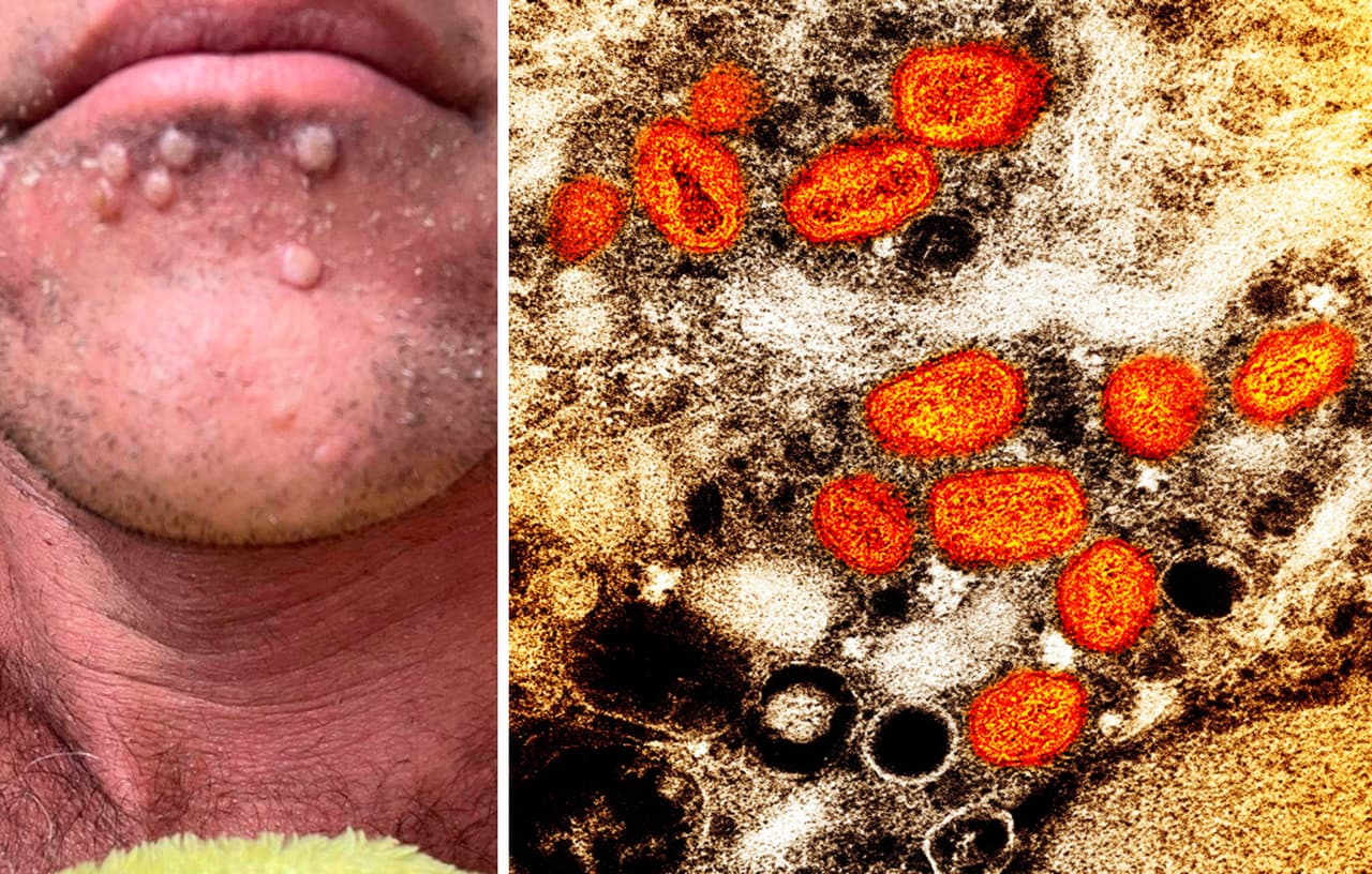 Muere una persona infectada con la viruela del mono en el condado de Los Ángeles