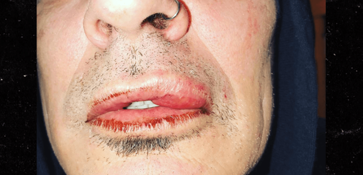 El hijo mayor de Pamela Anderson le rompe la boca de un puño a su papá, el rockero Tommy Lee