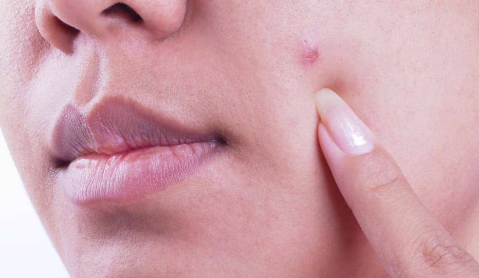 Exprimirse los granos. No hay nada peor que hacer esto, lo digo por experiencia. Se que es fuerte verte al espejo con un grano y peor aún si tiene punta blanca, pero si lo aprietas, la piel se inflama y muchas veces se nota más que si no lo tocas. Además la cicatriz que queda tarda mucho más tiempo en desaparecer. Mi mejor consejo, es aplicar un algodón con agua y aceite de Tee Trea sobre el brote. Verás que va mejorando y no queda cicatriz.