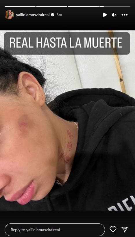 Además, publicó una fotografía en donde se 
<b><a href="https://www.univision.com/famosos/anuel-niega-golpeado-yailin-embarazada-acciones-legales">aprecian los presuntos golpes</a></b>. 
<br>