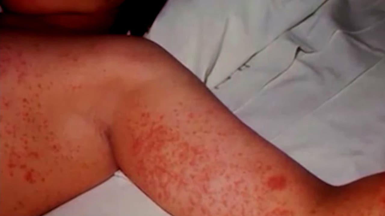 Confirman nuevo caso de sarampión en el Valle: Lanzan alerta por posible exposición en Queen Creek
