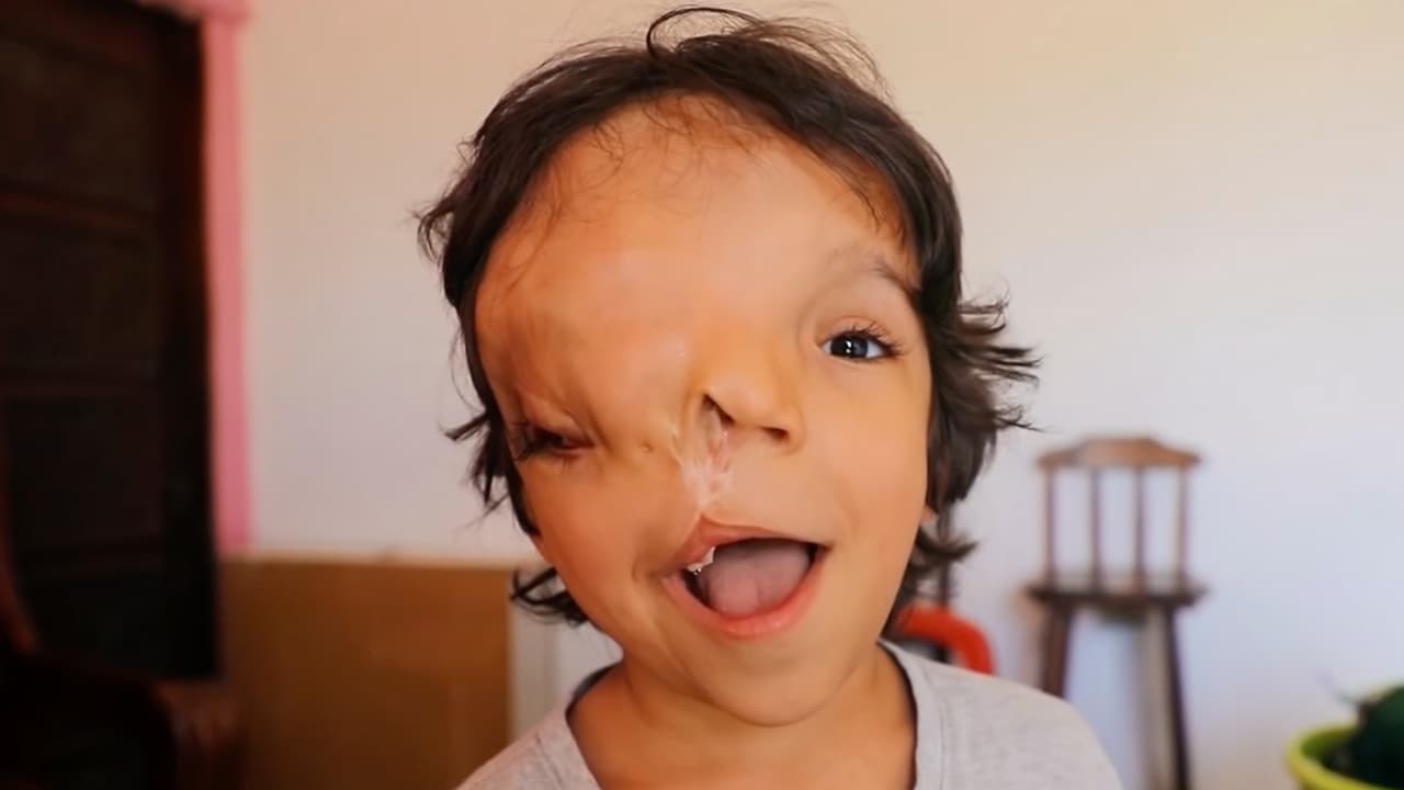 Buscan ayuda para salvarle un ojo a Lucas, un niño con una malformación en su cráneo y rostro