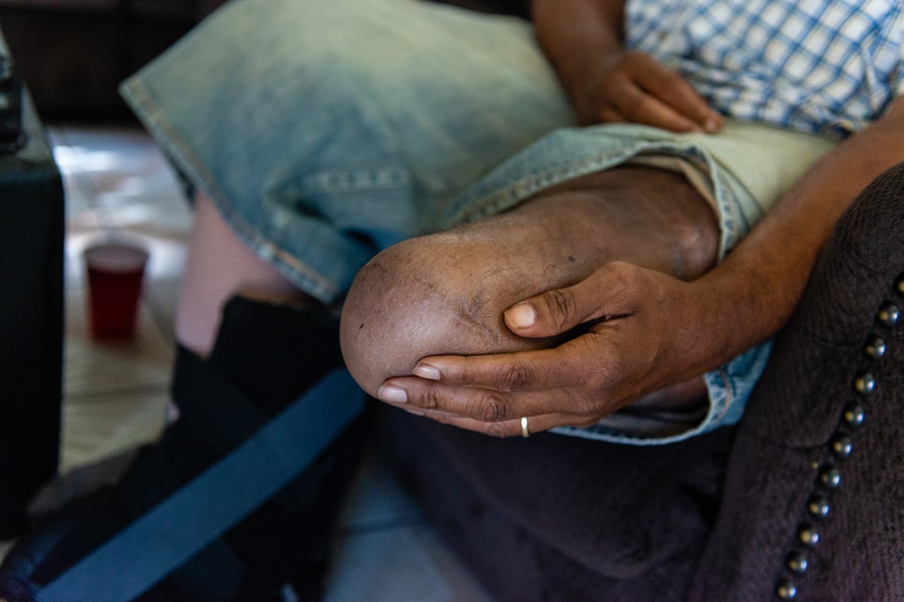 Jackson Moss tuvo que dejar de trabajar tras sufrir la amputación de su pierna izquierda por debajo de la rodilla hace 10 años por una infección que contrajo en un dedo.