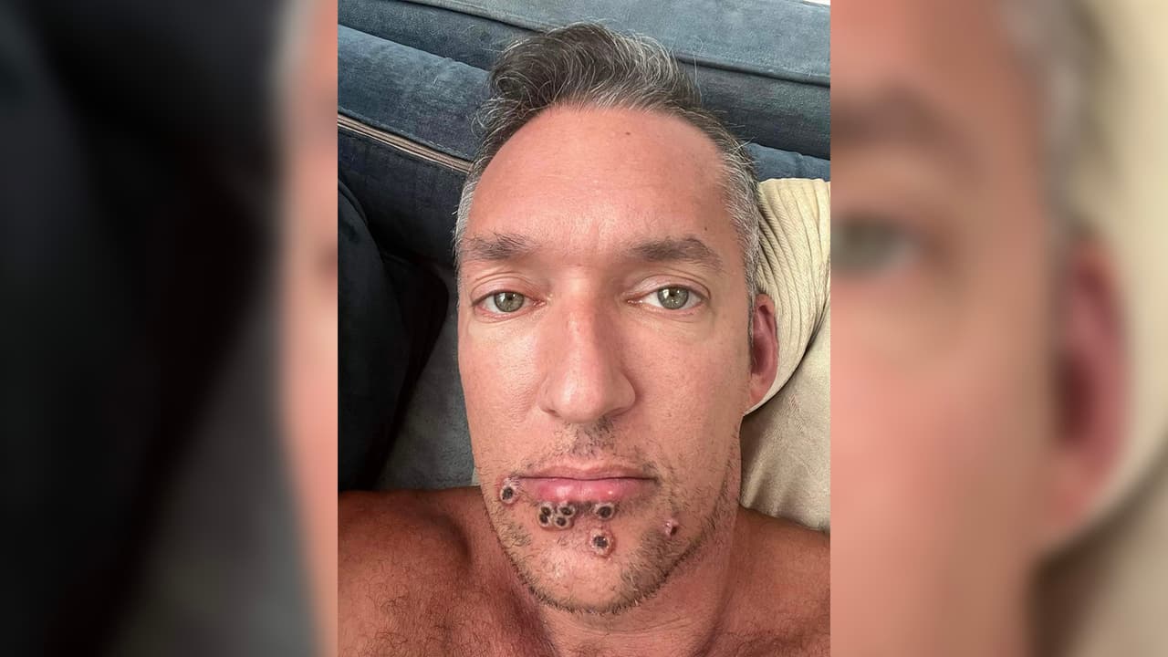 El contagio de la viruela del mono es mediante 
<b>contacto directo de la piel con fluidos corporales o al compartir ropa de cama, vestimenta o toallas.</b>