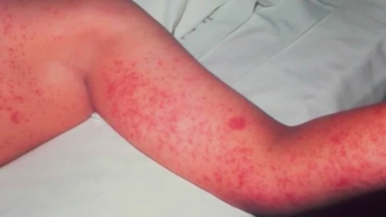 Pensilvania registra repunte de casos de sarampión; médico explica las razones