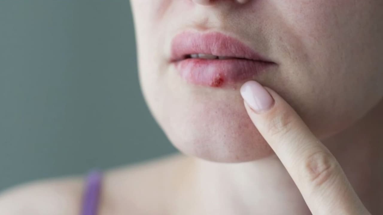 Pritelivir: Lo que debes saber del antiviral aprobado por la FDA contra el herpes en adultos con defensas debilitadas
