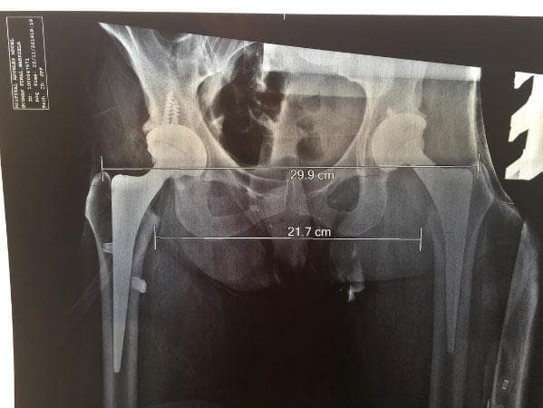 Desde 2014, Alejandra tuvo que vivir con una prótesis de titanio en la cadera.