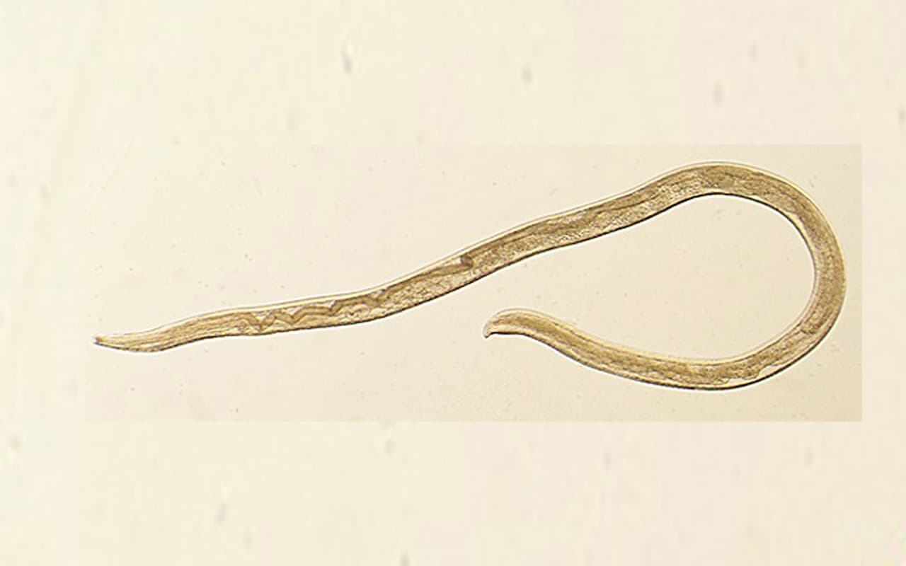 "¡Acabo de sacar un gusano de mi ojo!": registran el primer caso de una rara infección en humanos