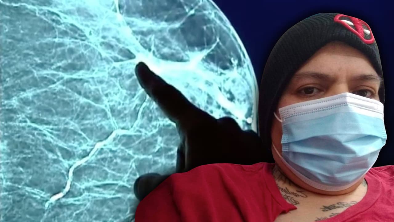 No fue al médico por miedo a contagiarse de covid-19 y ahora sufre cáncer de seno en fase 4