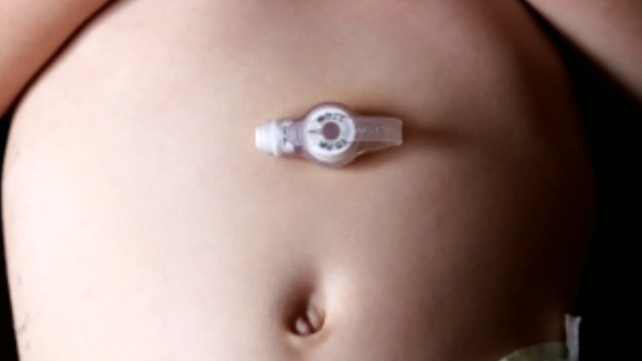 Sonda de alimentación.