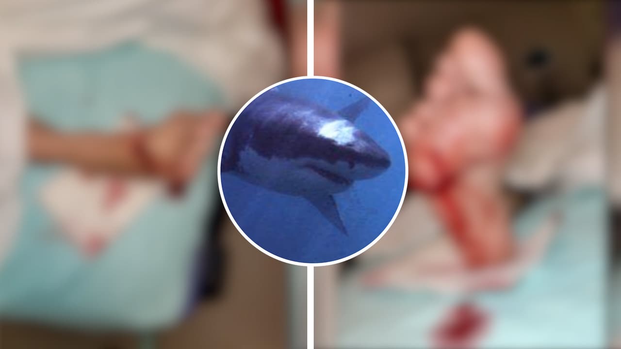 Tiburón muerde a mujer de 64 años mientras surfea en una playa de Florida 