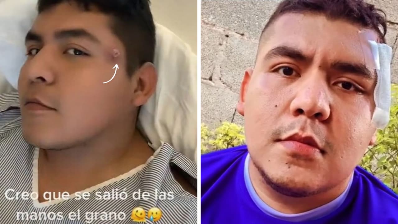 Creía tener una "espinilla enterrada" y descubre que era un tumor: contó lo que pasó en TikTok