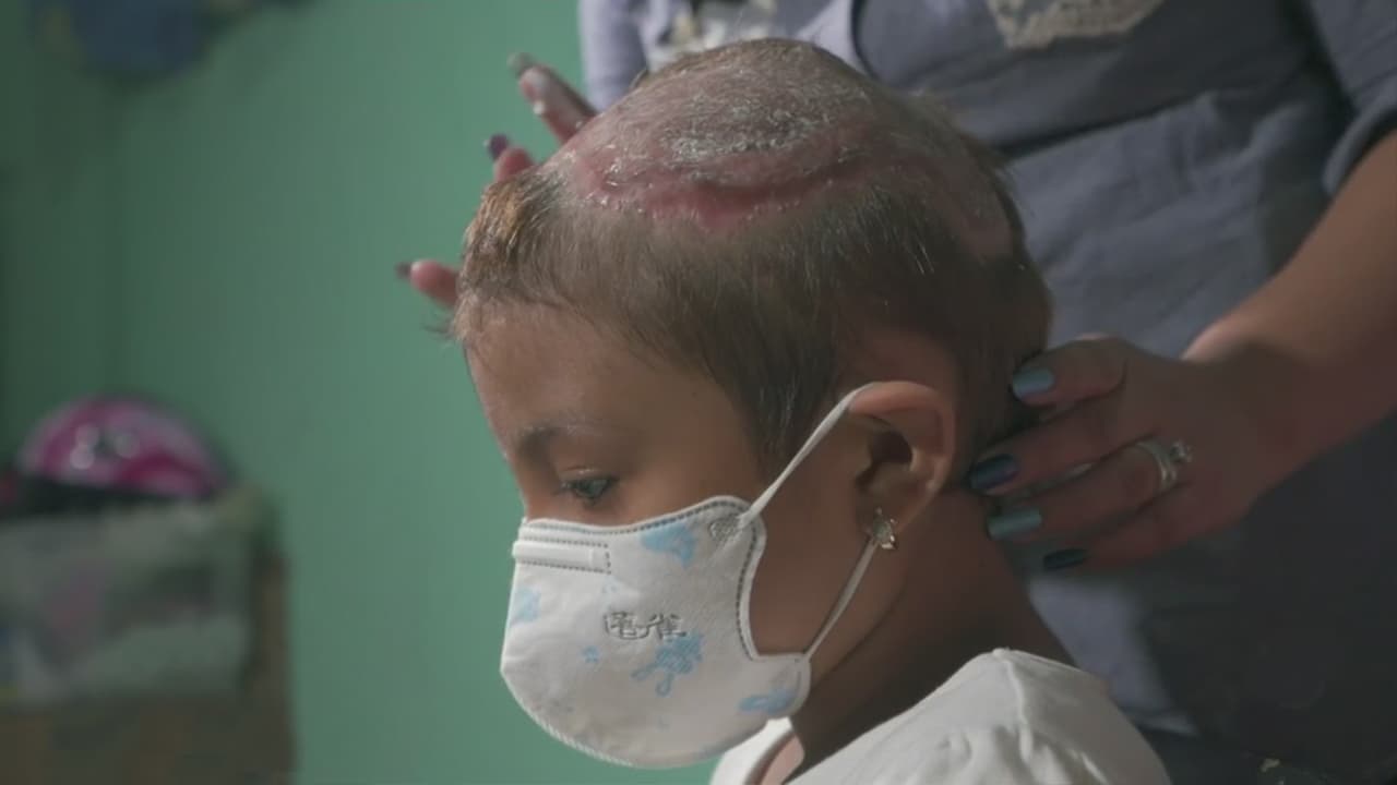 <b>Esta niña necesita ayuda: un perro pitbull le destrozó el cuero cabelludo</b>
<br>
<br>La pequeña, de 6 años, ha sido sometida a varias cirugías y tratamientos; sin embargo, no ha podido recuperarse totalmente debido a que necesita dinero para otros procedimientos y medicinas.